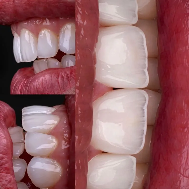 Análise estética de forma, textura e cor das facetas em resina