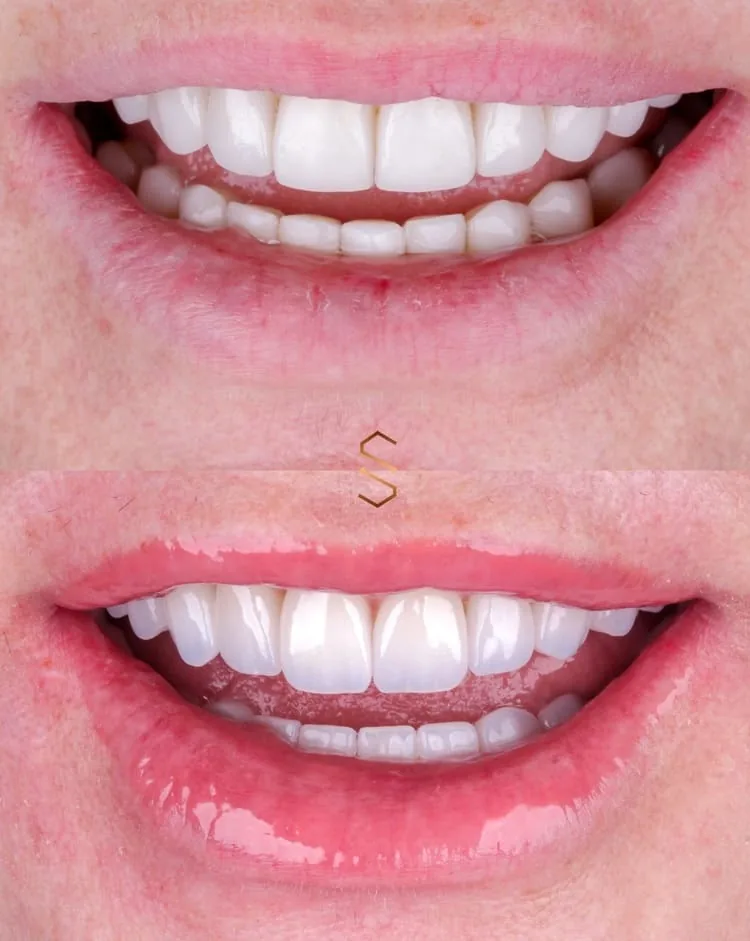 Antes e depois da estratificação de faceta em resina na região anterior
